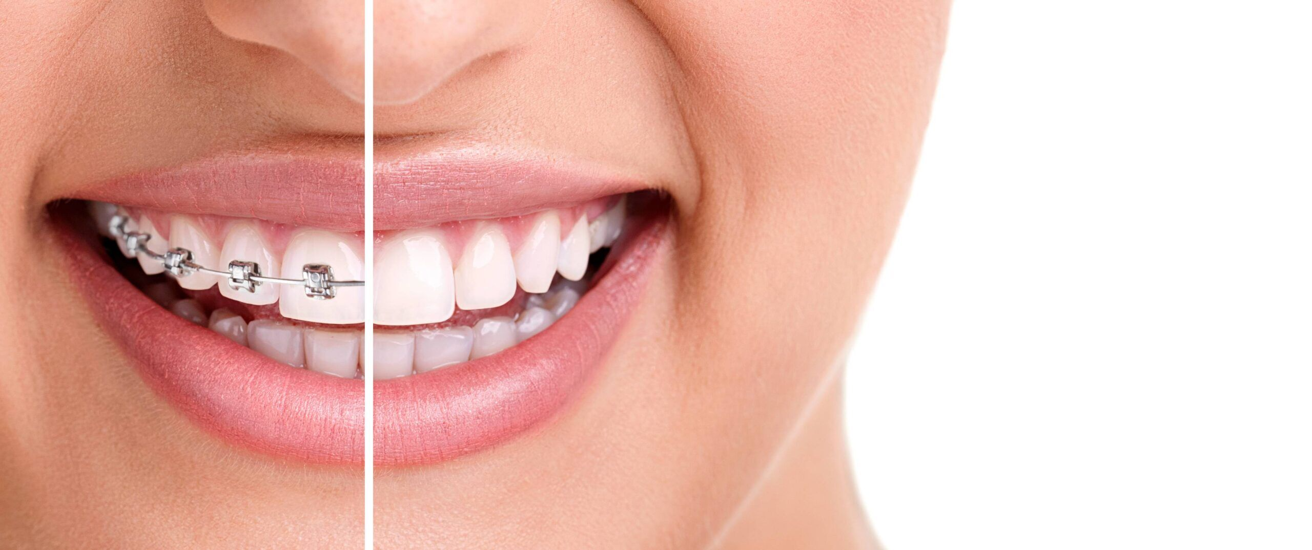 Customized Orthodontic Treatment Solutions For Your Smile